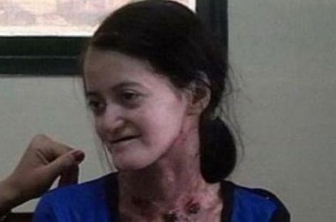 Tristeza. Falleció Virginia Gómez, la riojana con piel de cristal