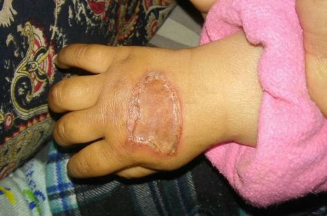 Bestial. Beba fue quemada adrede con un cuchillo caliente