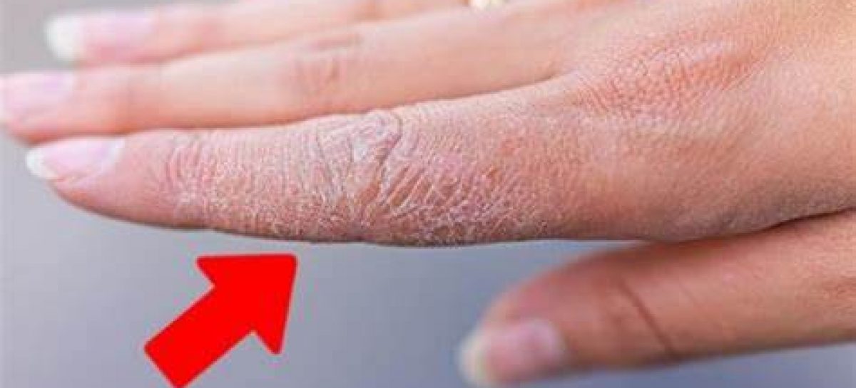 COVID. ADVIERTEN SOBRE LAS SECUELAS CUTÁNEAS QUE DEJÓ LA PANDEMIA