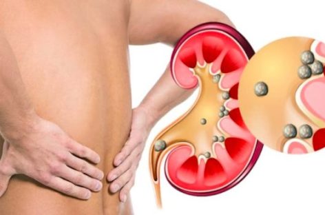 CERCA DEL 40% DE LAS CIRUGÍAS DE RIÑÓN SON POR LITIASIS