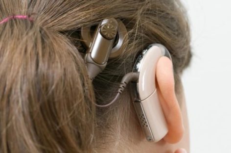 IMPLANTE COCLEAR. QUÉ ES Y QUIÉNES PUEDEN USARLO