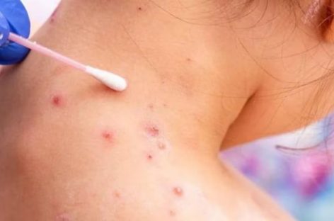 VIRUELA DEL MONO. LA RIOJA MANTIENE LA VIGILANCIA PARA PREVENIR CASOS
