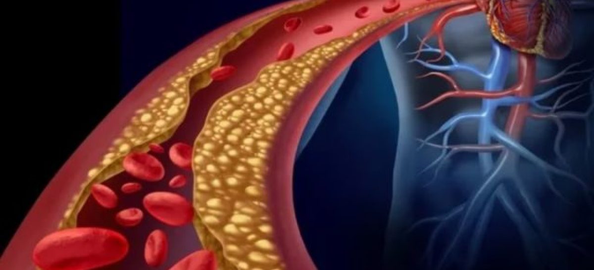 COLESTEROL ALTO. LOS SÍNTOMAS A DETECTAR Y CÓMO PREVENIR ENFERMEDADES CARDIOVASCULARES