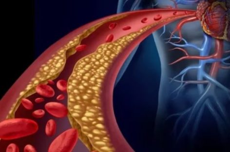 COLESTEROL ALTO. LOS SÍNTOMAS A DETECTAR Y CÓMO PREVENIR ENFERMEDADES CARDIOVASCULARES
